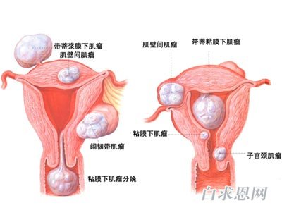 子宫肌瘤