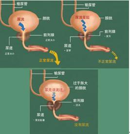 前列腺增生